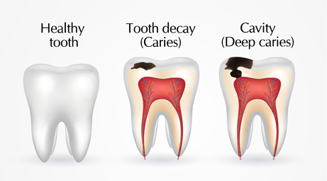 tooth decay caries and cavity