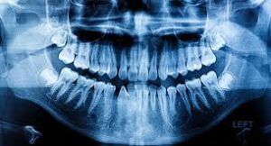 dental x-ray image