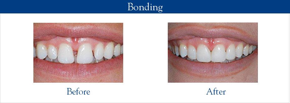 Dental Bonding