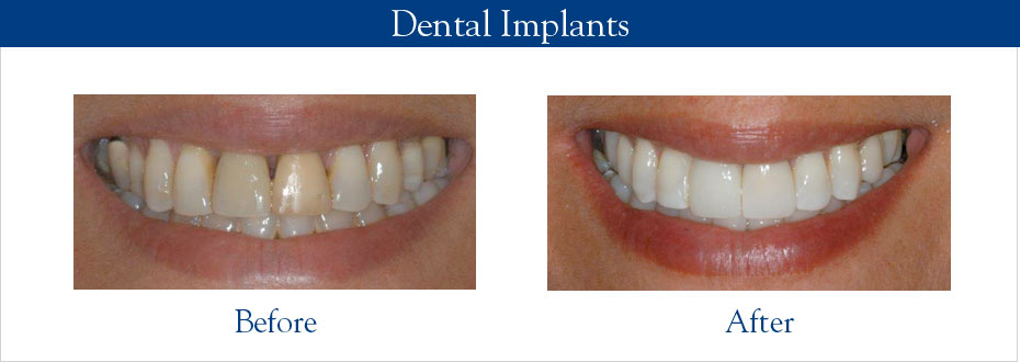 Dental Implants