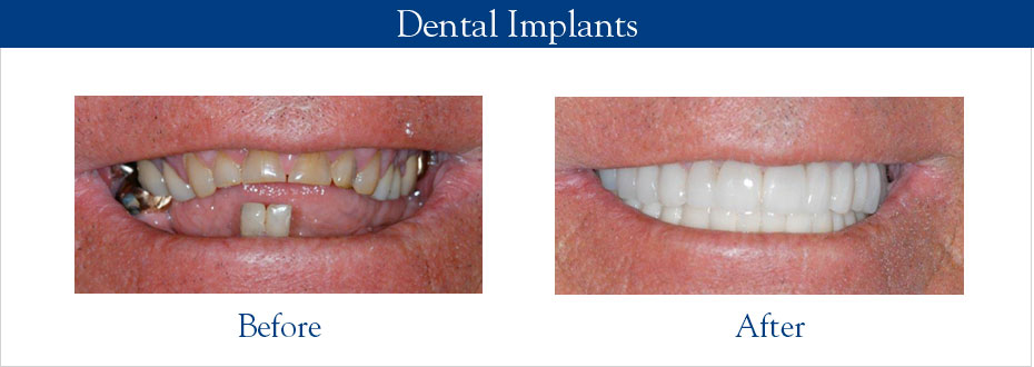 Dental Implants