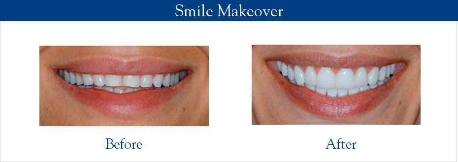 Smile Makeover