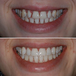 Carroll Dentistry, Cosmetic Dentistry, Miami Beach Dentist, Tooth Whitening, Family Dentistry, Bioclear, Bonding