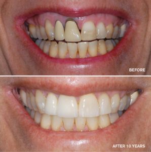 Carroll Dentistry, Cosmetic Dentistry, Miami Beach Dentist, Tooth Whitening, Family Dentistry, Bioclear, Bonding,