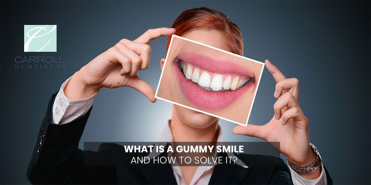 You are currently viewing What Is a Gummy Smile And How To Solve It?