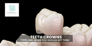 Read more about the article Teeth Crowns – Types and When you Should Get Them