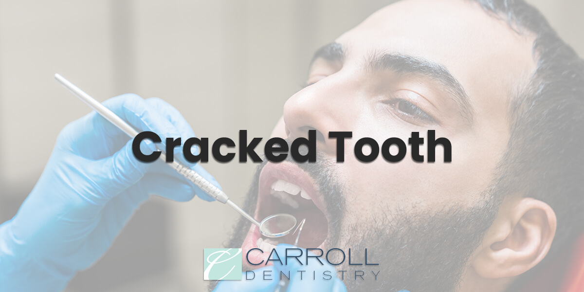 Read more about the article Cracked Tooth