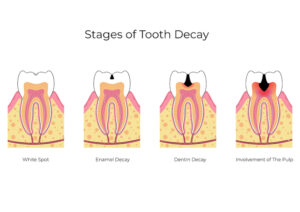 dental caries