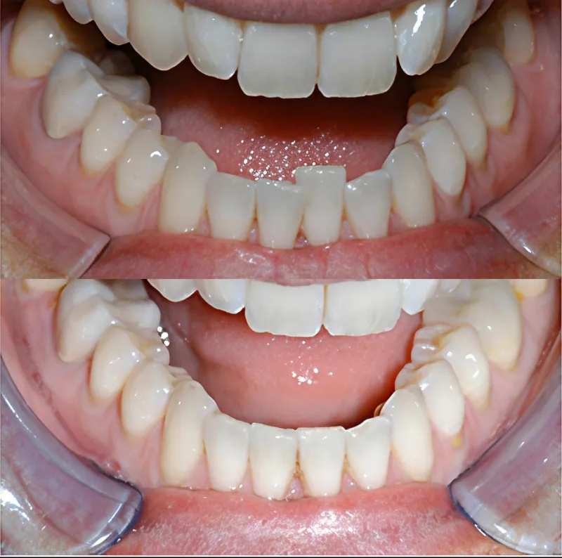 adult-orthodontics-slide-1