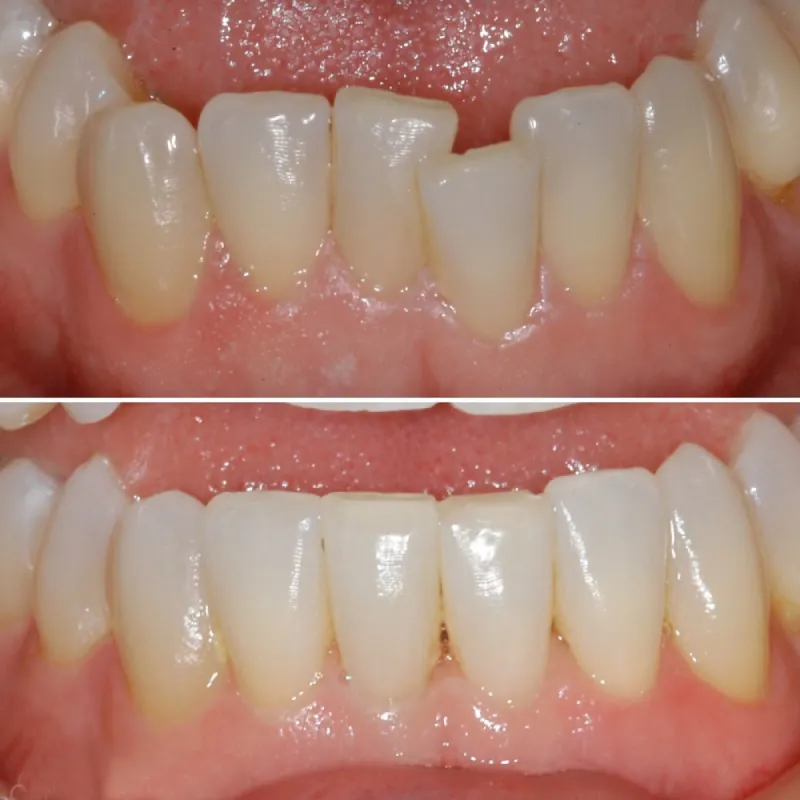 adult-orthodontics-slide-3