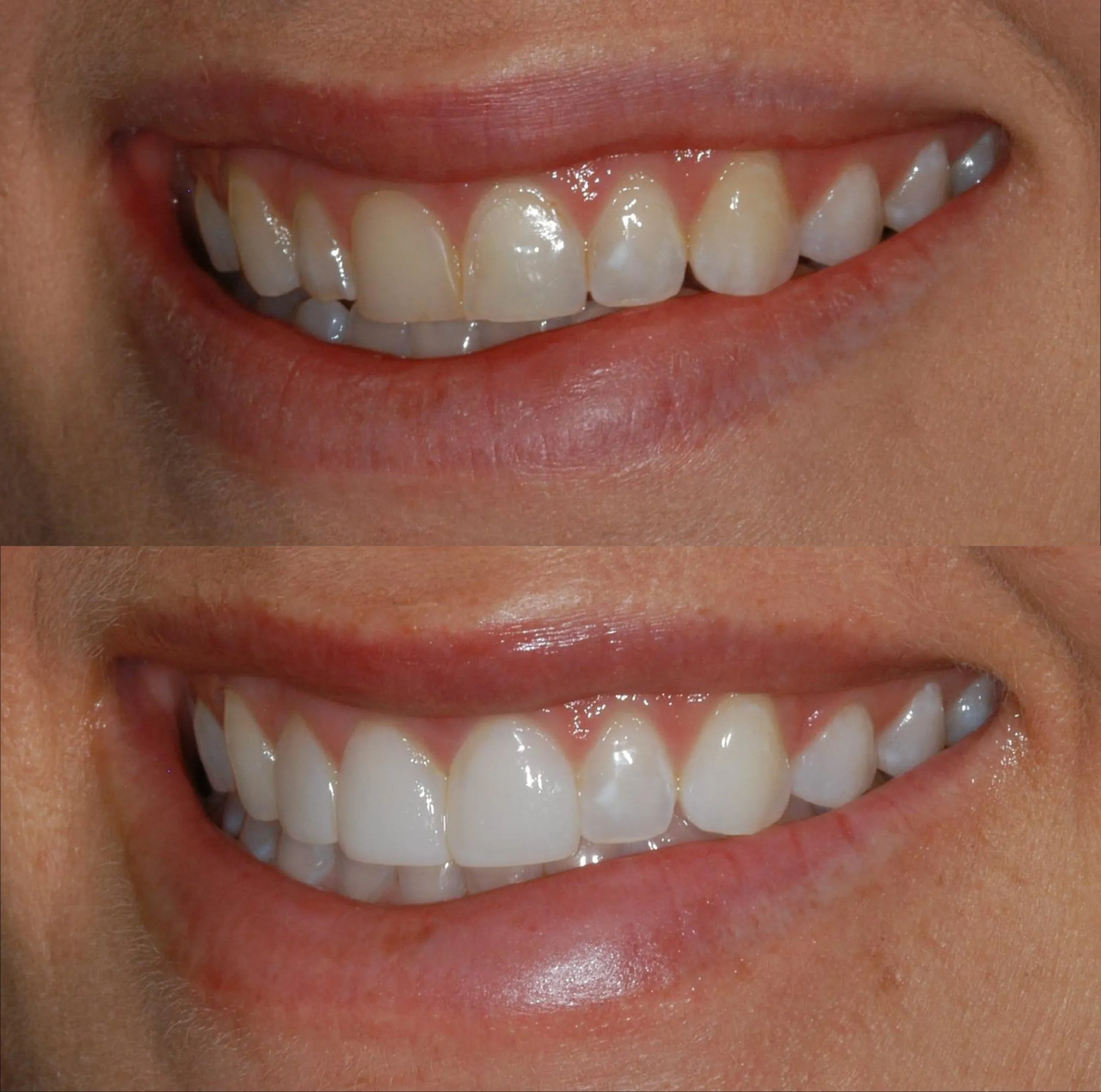 composite-fillings-slide-1