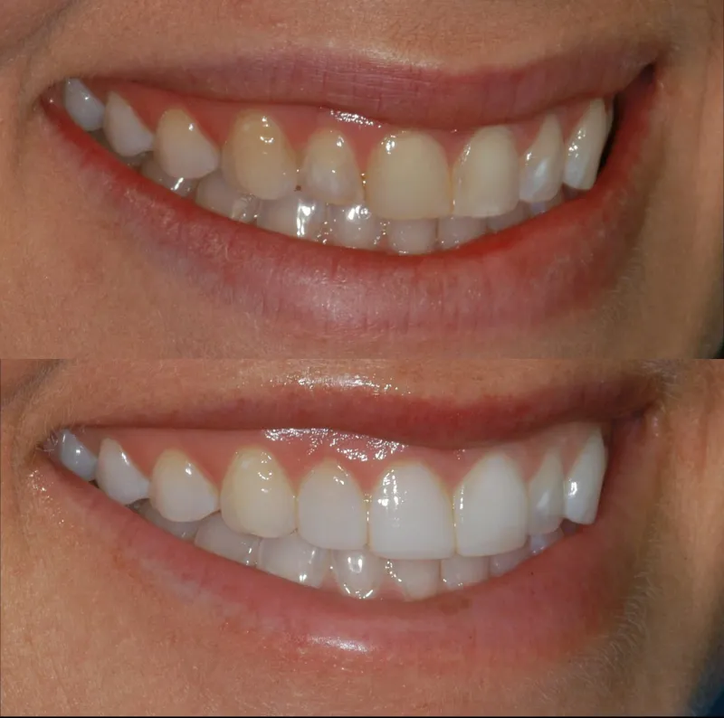 composite-fillings-slide-3