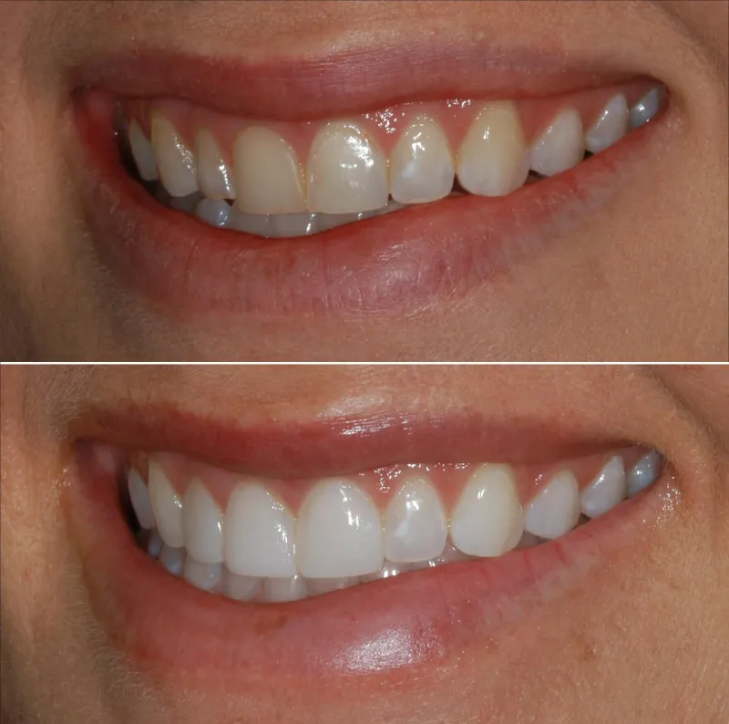 composite-fillings-slide-5