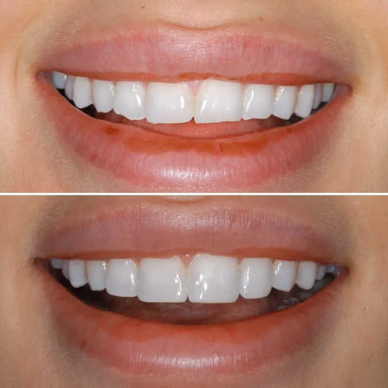 dental-bonding-slide-1