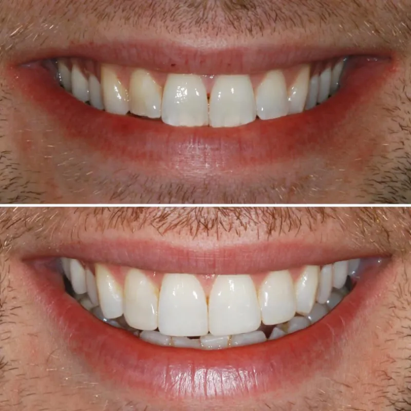 dental-bonding-slide-2