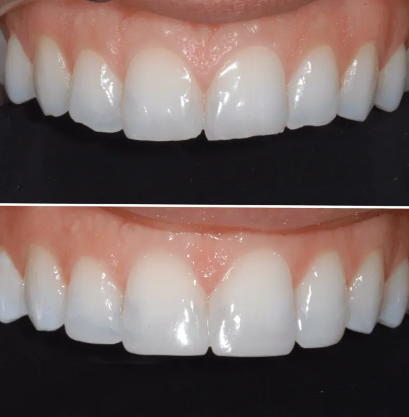 dental-bonding-slide-3