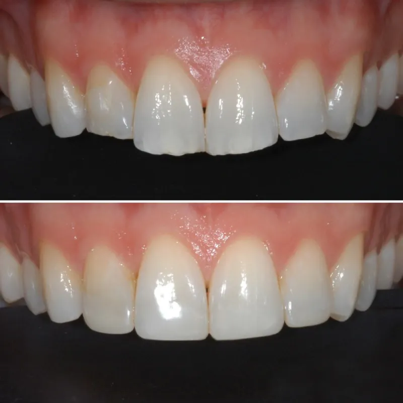 dental-bonding-slide-4