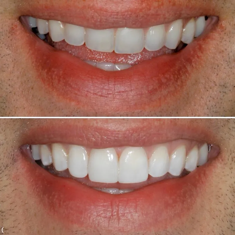 dental-bonding-slide-5