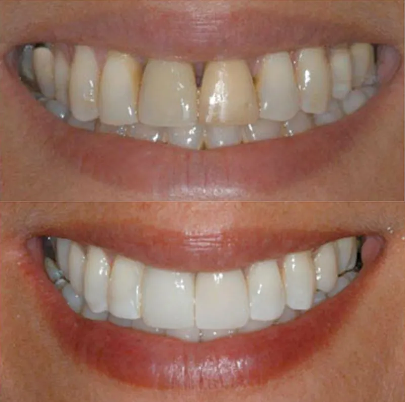 dental-implants-slide-1