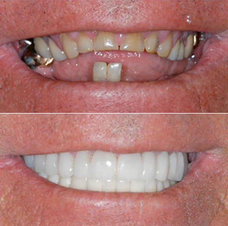 dental-implants-slide-2
