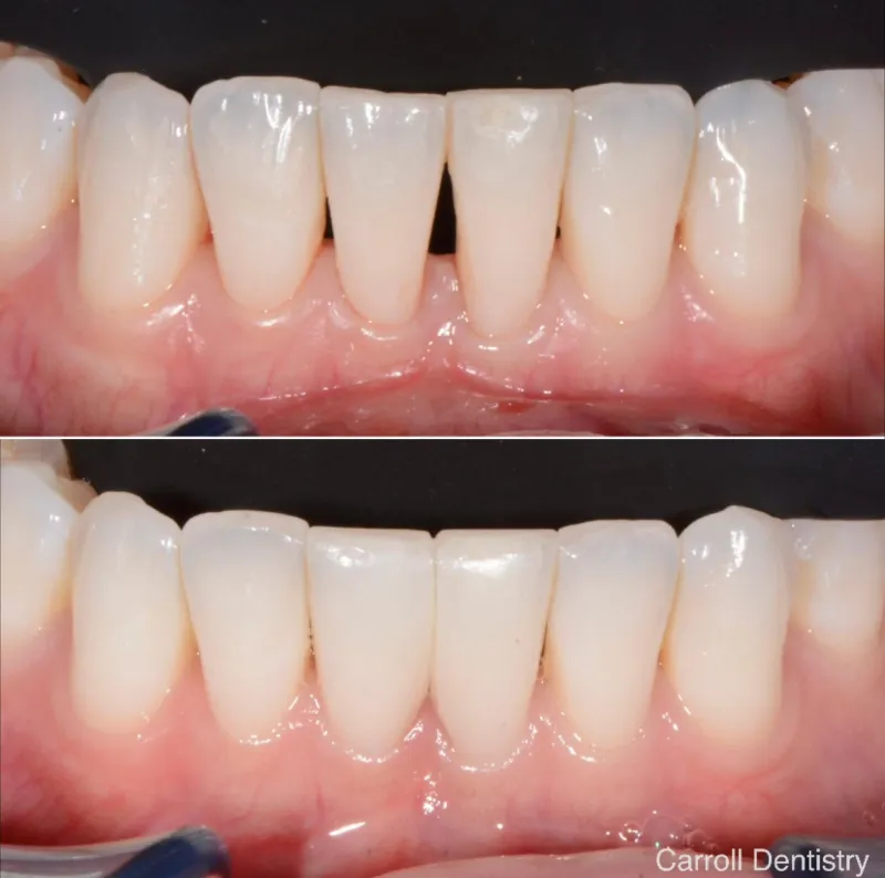 dentures-slide-2