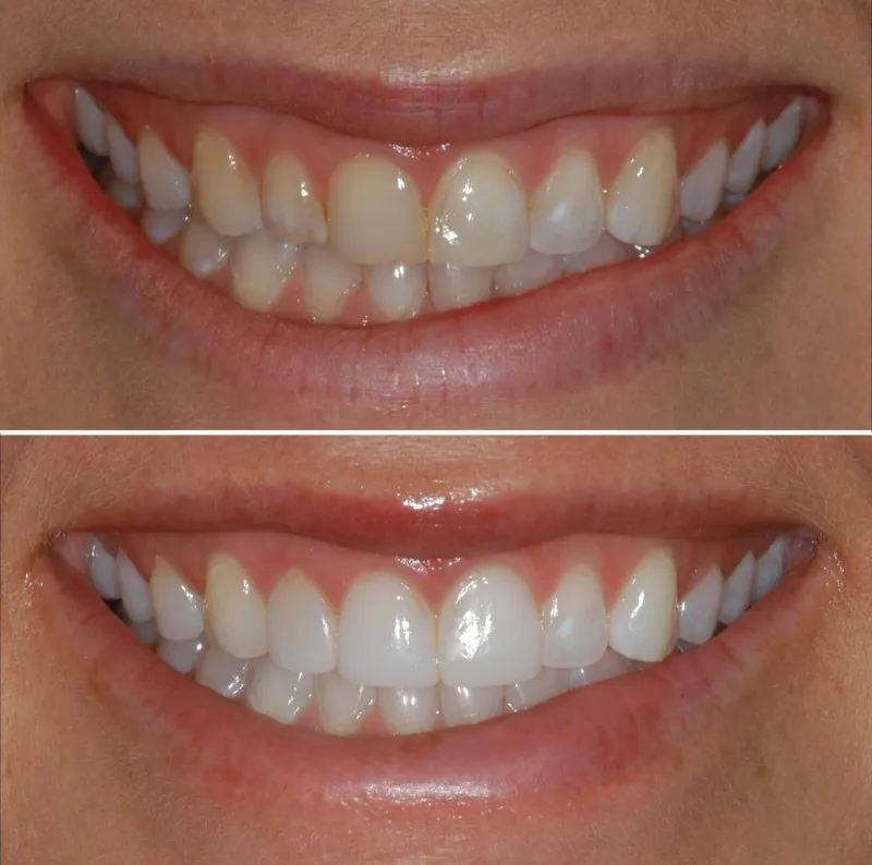 dentures-slide-4