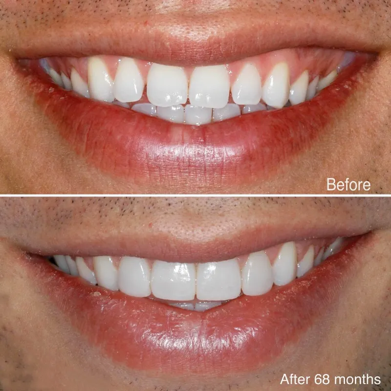orcelan-veneers-slide-1