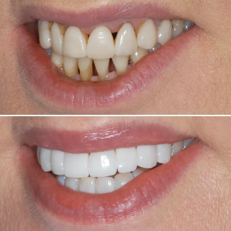 porcelain-crowns-slide-1