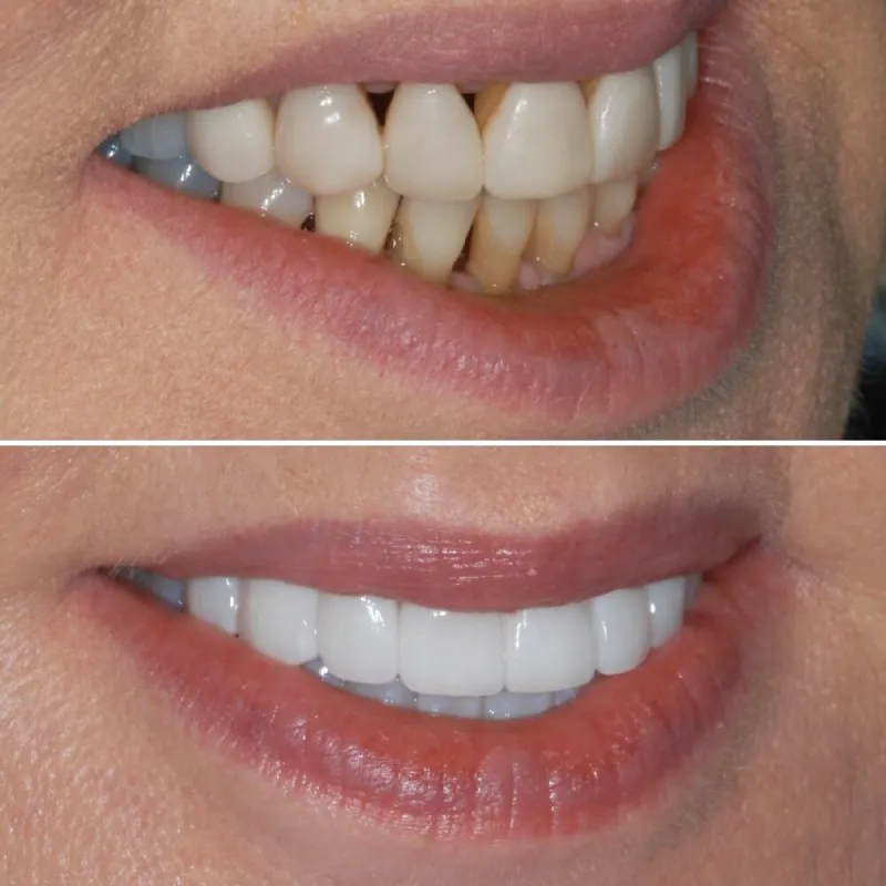 porcelain-crowns-slide-2