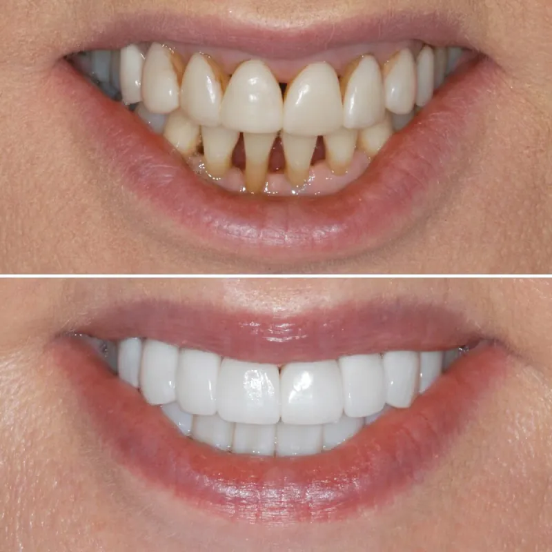 porcelain-crowns-slide-3