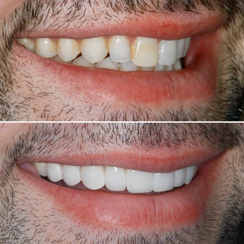 porcelin-veneers-slide-2