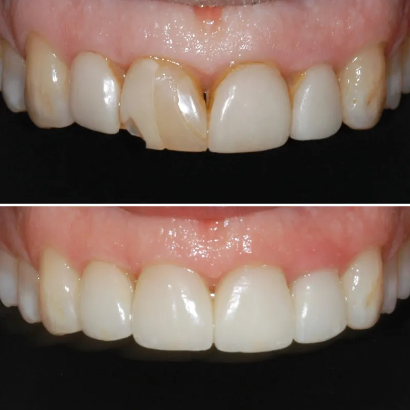 porcelin-veneers-slide-3
