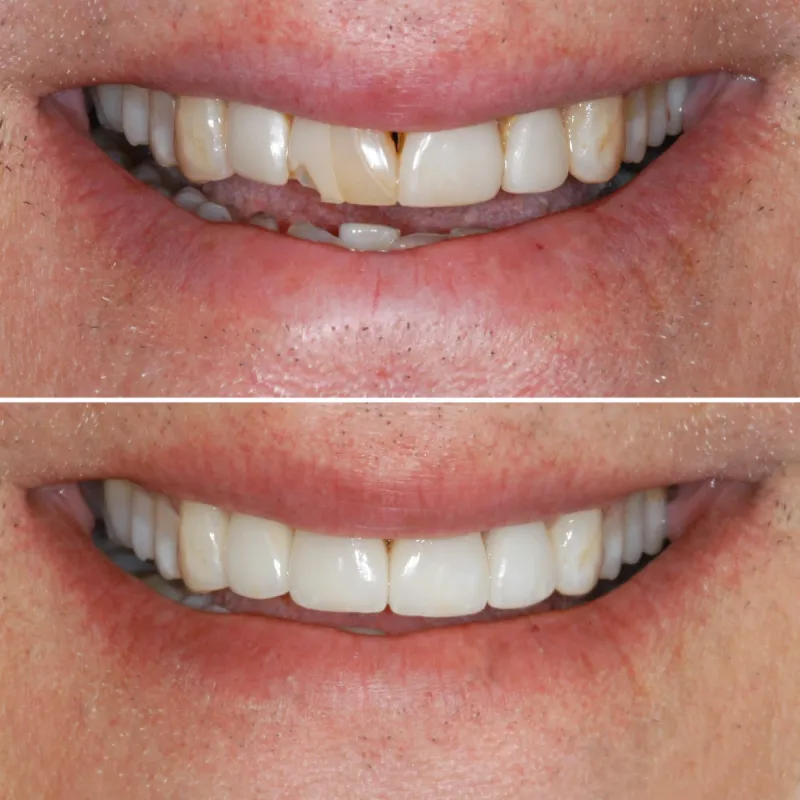 porcelin-veneers-slide-4