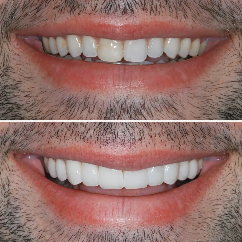 porcelin-veneers-slide-5