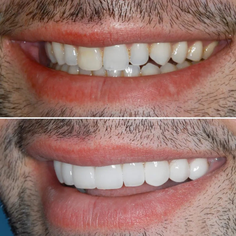 porcelin-veneers-slide-6
