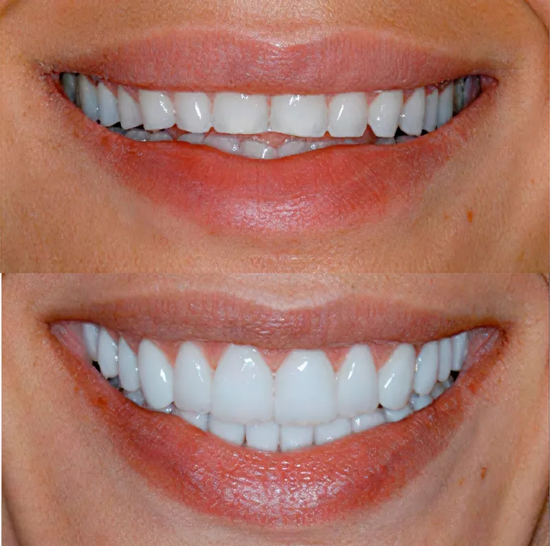 smile-makeover-slide-1