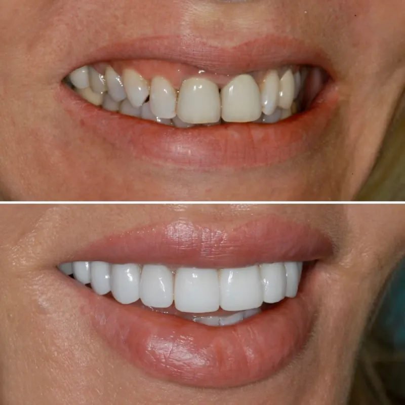 smile-makeover-slide-2