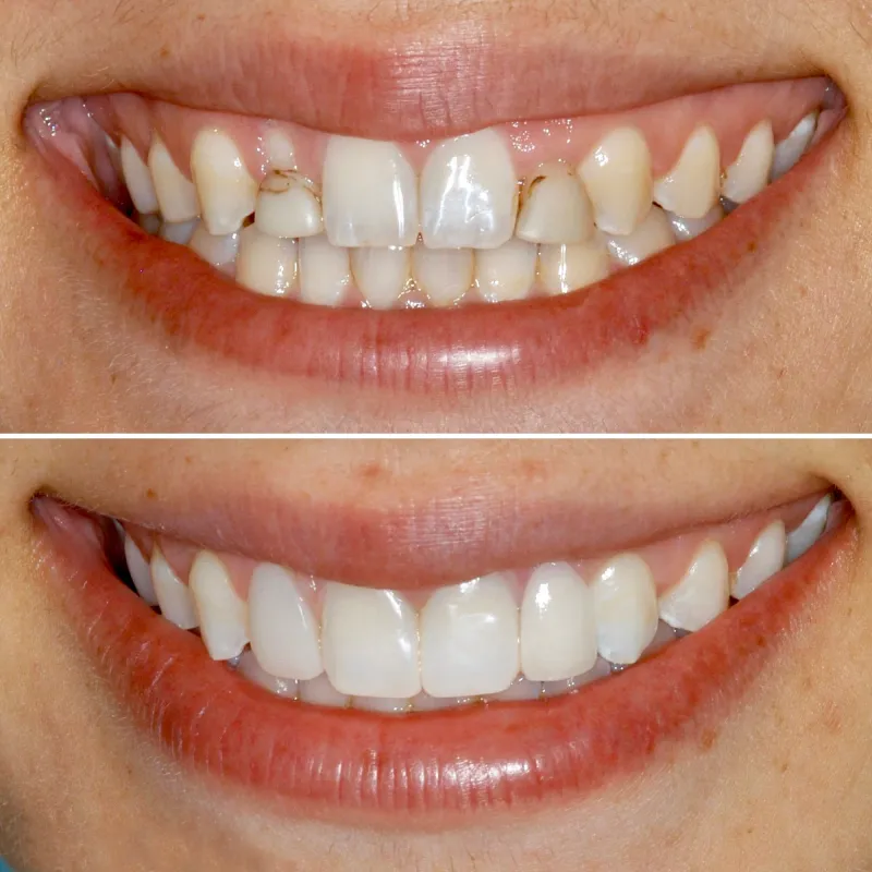 smile-makeover-slide-3