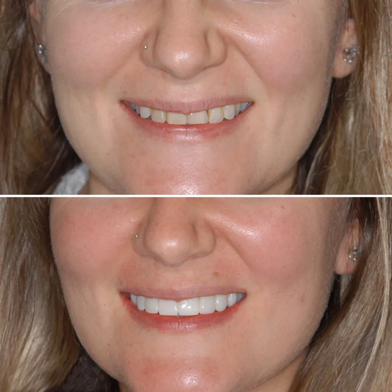 smile-makeover-slide-4