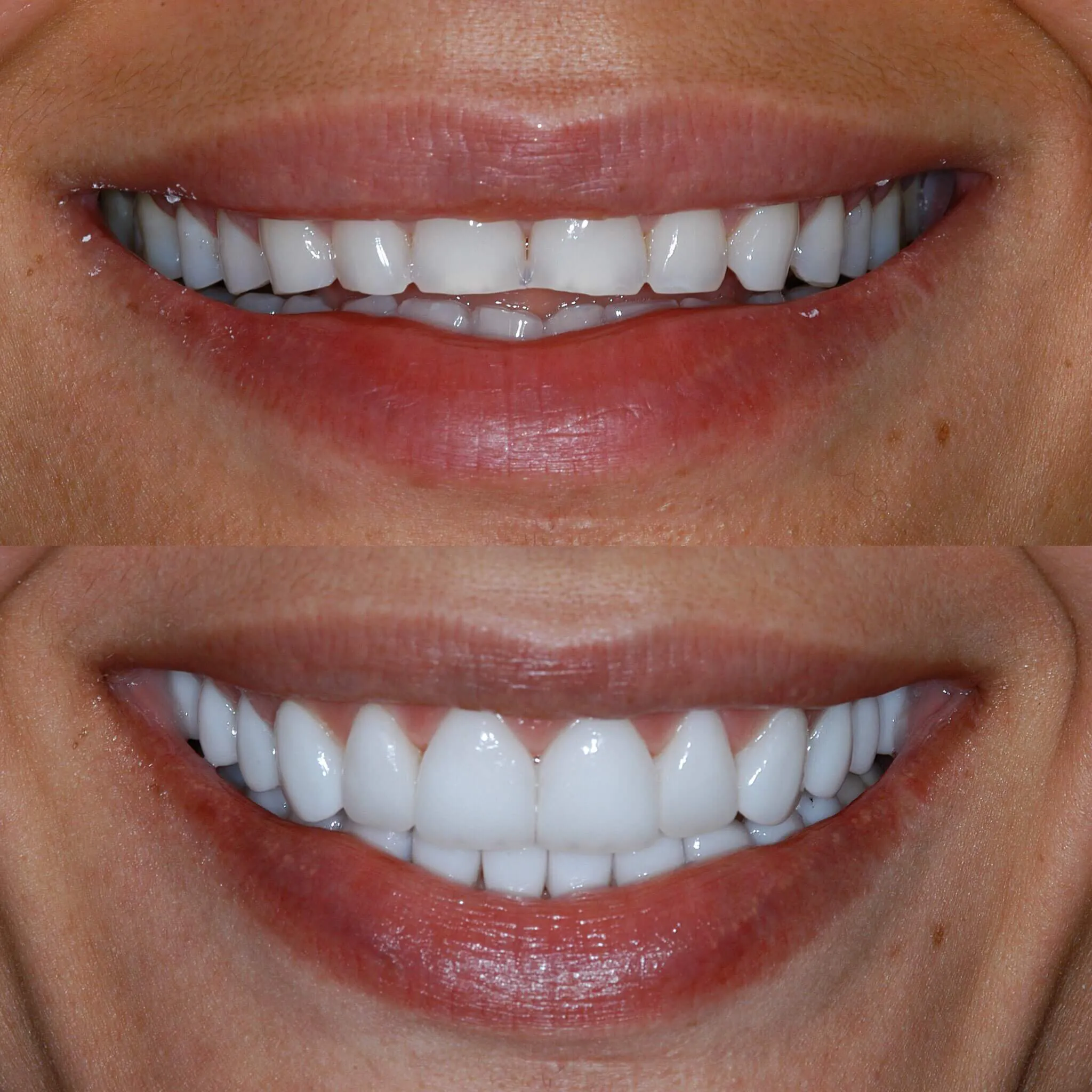 smile-makeover-slide-5