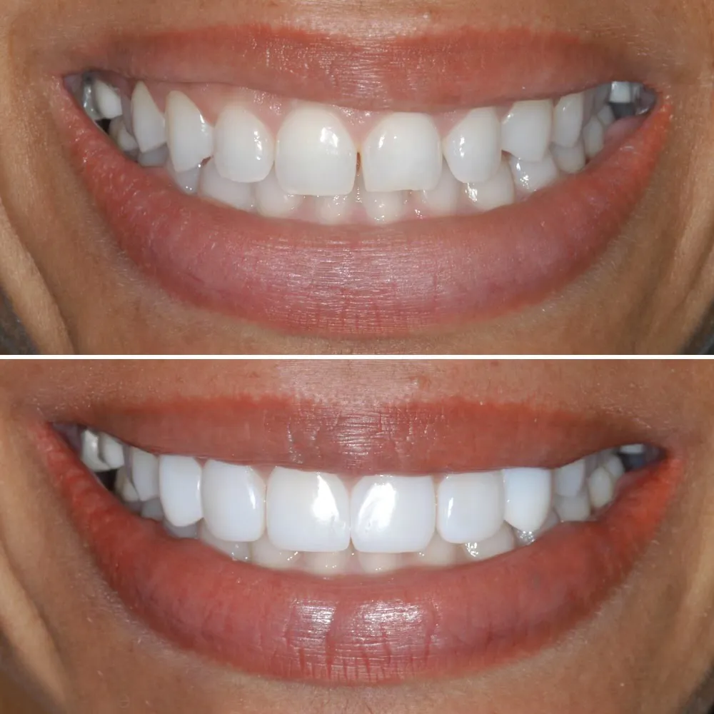 smile-makeover-slide-6