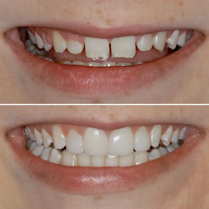 smile-makeover-slide-7