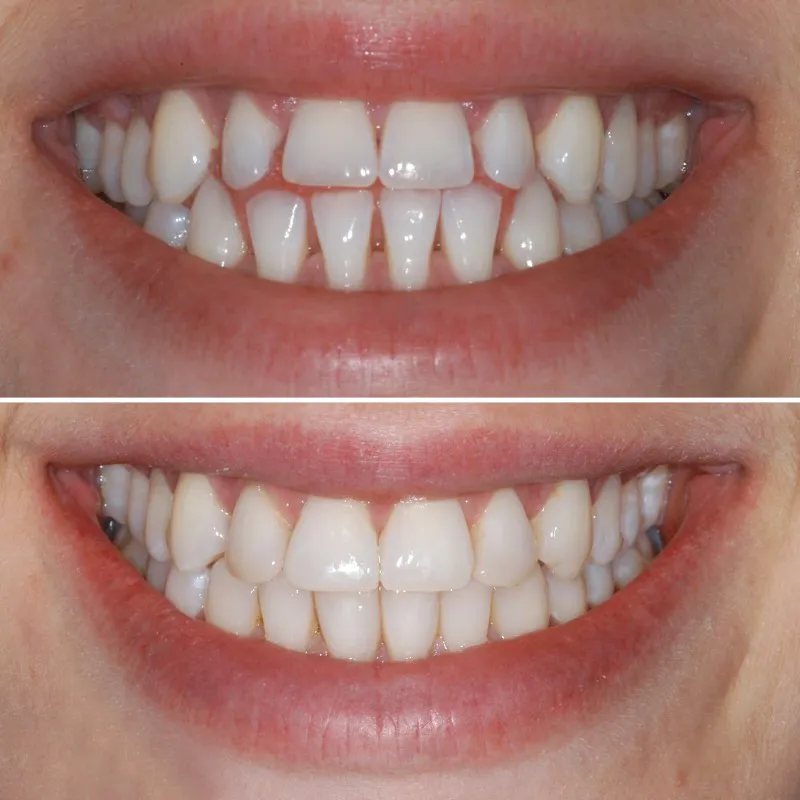 smile-makeover-slide-8